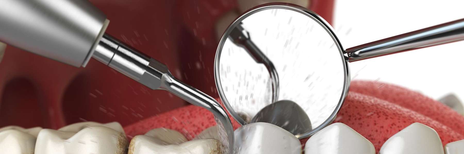 Teeth being cleaned, tampa florida