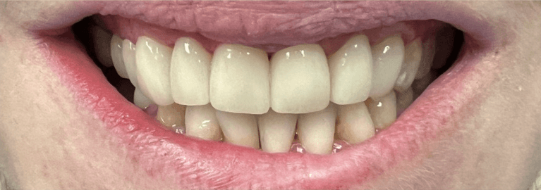 After 8 ceramic crowns, tampa fl