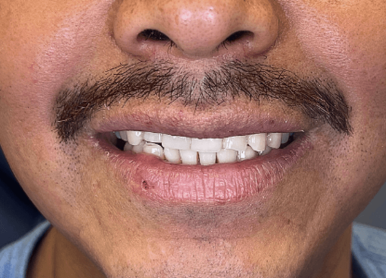 After front tooth implant restoration, tampa fl