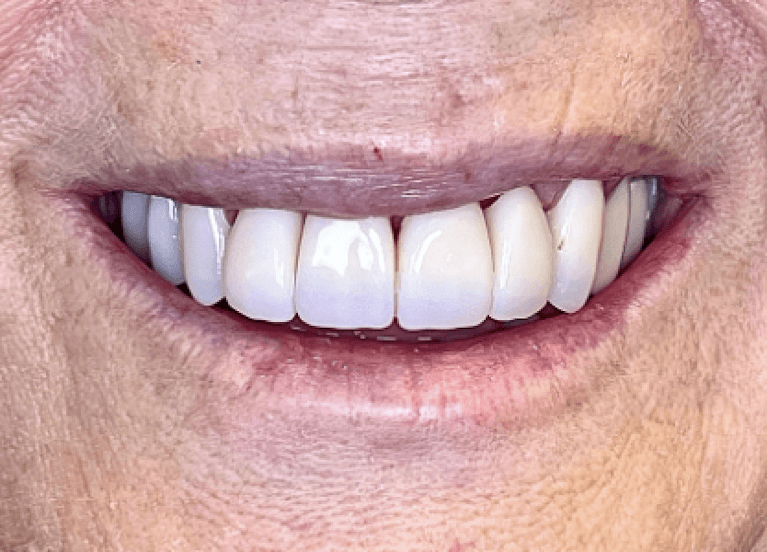 After 8 hollywood smile crowns, tampa fl