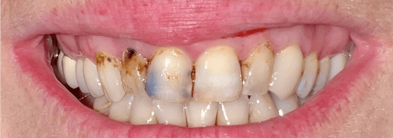 Before 8 ceramic crowns, tampa fl