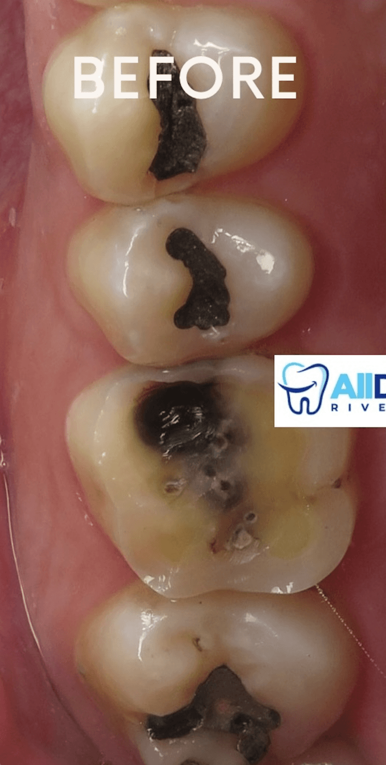 Before tooth colored fillings, tampa fl