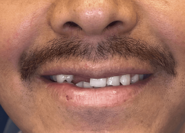 Before front tooth implant restoration, tampa fl