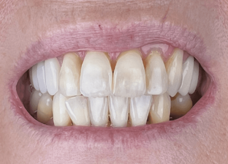 Before 8 hollywood smile crowns, tampa fl