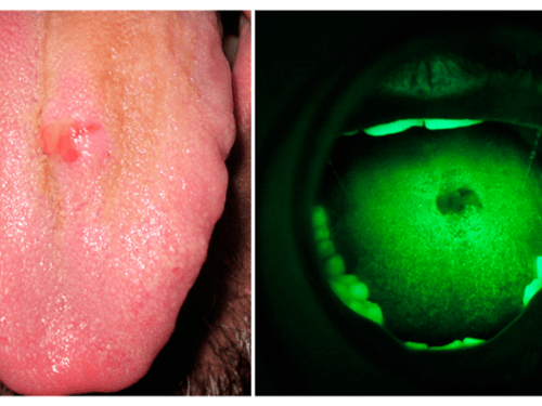 VELscope Oral Cancer Screening 